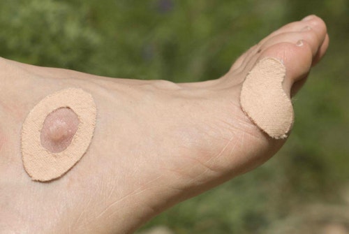 Blisters are the No. 1 hiker/hunter injury. While not life threatening, blisters can certainly be painful and end a bowhunt in a hurry. Before hitting the trail, place moleskin over areas where you commonly develop blisters. As you hike, take time to cover any hot spots that develop with moleskin, which protects your skin from the rubbing that causes blisters. If you have a formed blister, use moleskin to raise up the area around the blister to protect it from painful rubbing. Cut the moleskin into a doughnut shape (or grab a pre-shaped, die-cut moleskin) and place around the blister. You might need a few layers to raise the area enough. Fill the doughnut hole with antibiotic ointment, then cover the area with tape.